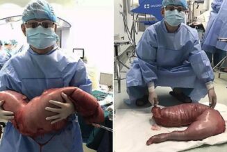 Ärzte entfernen 13 Kilo Kot von Mann mit Verstopfung