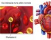 Cholesterin verursacht KEINE Herzkrankheit