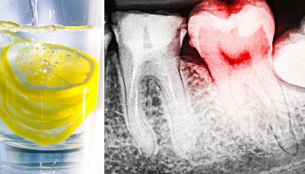 Zitronenwasser zerstört Ihre Zähne. So beheben Sie das Problem!