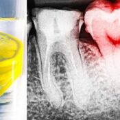 Zitronenwasser zerstört Ihre Zähne. So beheben Sie das Problem!