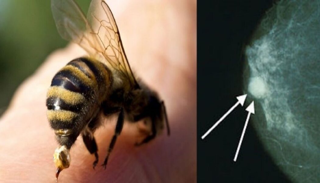 Studie des Instituts für Medizinische Forschung zeigt: Honigbienengift tötet aggressive Brustkrebszellen schnell ab