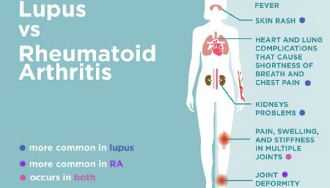 Arthritisbedingte Autoimmunerkrankungen, einschließlich Lupus, Fibromyalgie und rheumatoide Arthritis
