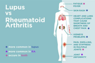 Arthritisbedingte Autoimmunerkrankungen, einschließlich Lupus, Fibromyalgie und rheumatoide Arthritis
